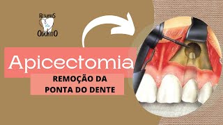 APICECTOMIA  Resumos de Odonto [upl. by Dorolice646]