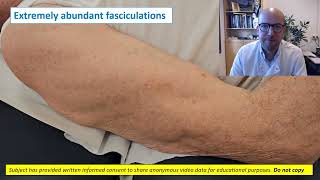 Needle EMG fasciculations [upl. by Araas]