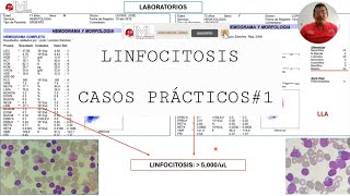 LINFOCITOSIS CASO CLÍNICO DE LLC VS LLA [upl. by Ollie]