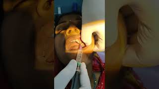 Infraorbital Nerve Block Technique [upl. by Artep]