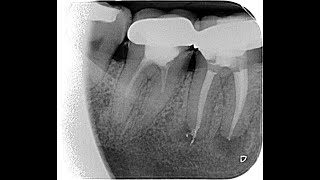 Commentaires live  Retraitement endodontique  46 sous couronne 3 canaux mésiaux [upl. by Salohcim]