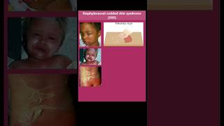 staphylococcal scalded skin syndrome SSSS [upl. by Tiloine621]