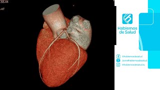 ANGIOTOMOGRAFÍA CORONARIA  DR FEDERICO LANDETA [upl. by Niroc99]