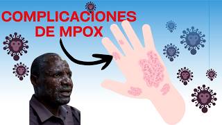 4 peores complicaciones de la viruela mpox [upl. by Ahsekyw]