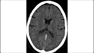 Vein of Galen and straight sinus thrombosis [upl. by Lani]