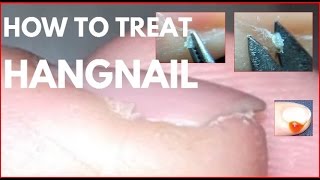 How to treat hangnails Agnail treatment [upl. by Shipp]