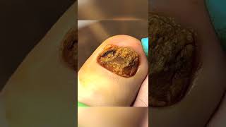 Psoriasis in your toenails footdoctor toenails nails [upl. by Yee]