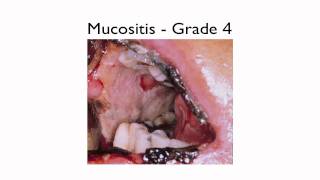 What is Mucositis [upl. by Dadirac]