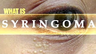 What is Syringoma  Usapang Pangkalusugan [upl. by Enihpled]