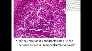 Chondroblastoma shows Chiken wire calcification [upl. by Blas]