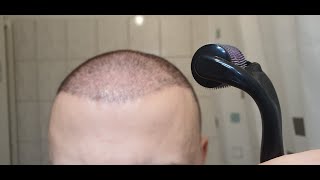 Minoxidil amp Dermarolling Results 6 MONTHS  Month by Month Progress [upl. by Jarin745]