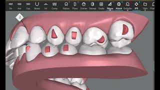 Invisalign clincheck simulation Cross bite correction Is it possible [upl. by Vivi456]