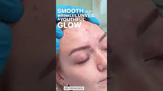 Forehead Botox for a Youthful Glow  EDEN AESTHETICS Dubai [upl. by Anieral]