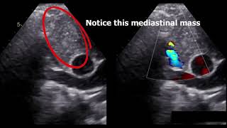 SVC syndrome diagnosis by echocardiography [upl. by Godding]