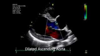 Bicuspid Aortic Valve [upl. by Brom]