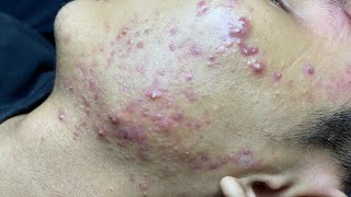 ACNE TREATMENT VU QUYNH MI Blackheads On Boy Face 2024 [upl. by Lledniw]