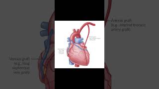 CABGCoronary artery bypass grafting [upl. by Noram]