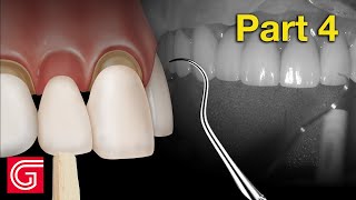 HOW TO TryIn Zirconia Crowns BEFORE Final Cementation [upl. by Niwrud]