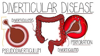 Understanding Diverticular Disease Diverticulosis and Diverticulitis [upl. by Bobbie]