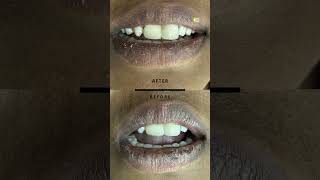 smiledesigning trichy thiruchirapalli dentist dranbudentist [upl. by Ziana243]