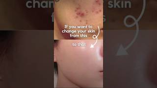 Remove Acne amp Pimples amp Get Clear Flawless Skin [upl. by Cai]