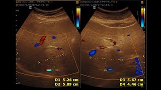 Ultrasound cases 494 of 2000  Hemangioma Grade 1 Fatty Liver [upl. by Atilrak]