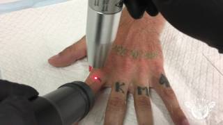 HAND AND FINGER TATTOO REMOVAL  EXPIRED LASER STUIO [upl. by Fi]