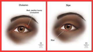 Chalazion vs Stye [upl. by Oiramad]