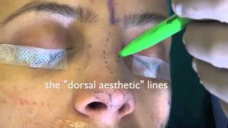 Rhinoplasty Surface Aesthetics and Surgical Techniques [upl. by Stuckey989]