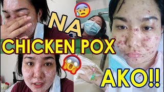 ANG CHAKA MY CHICKENPOX EXPERIENCE VLOG 8 Bacolodnon  jaygee [upl. by Lowenstern]