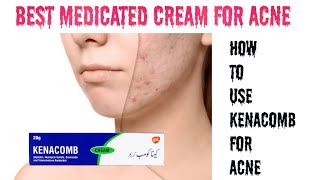 Best medicated cream for Acne and pimples  How to use kenacomb cream for Acne [upl. by Isobel193]