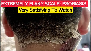 Satisfying Removal of Extremely Flaky Scalp Psoriasis  Causes amp Removal [upl. by Eahsal]