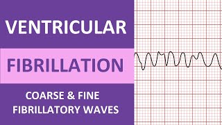 Ventricular Fibrillation VFib ECG Interpretation Nursing Heart Rhythms NCLEX ACLS [upl. by Niwled]