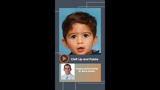 Cleft Palate Transformation Santiago [upl. by Dehlia]