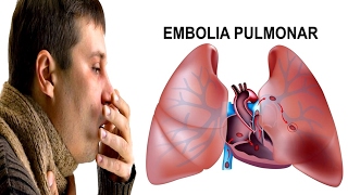 Embolia pulmonar  Sintomas Tratamentos e Causas [upl. by Atsirhc]