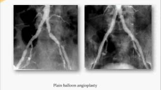 Aorto Iliac Disease  Part 2 [upl. by Leterg]