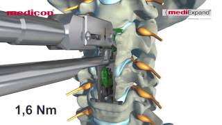 MEDICON  quotmediExpand®quot Cervical [upl. by Kacie]