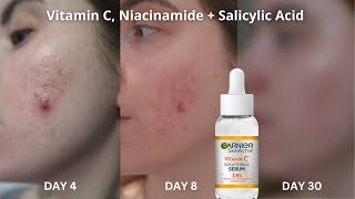 30 Days OfGarnier Vitamin C Serum  Salicylic Acid amp Niacinamide  Acne Pigmentation [upl. by Nnylyaj]