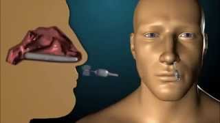 Rapid Rhino Epistaxis Device [upl. by Potts126]