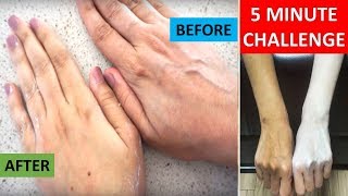 This remedy to Lighten Skin works ELBOWKNEEUNDERARM CHALLENGE  INSTANT WHITENING [upl. by Raffo499]