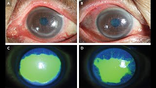 Keratokonjunktivitis sicca bei Sjögren Syndrom [upl. by Martha49]