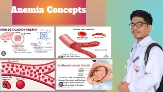 Iron Deficiency Anemia Hemolytic Anemia  Effects of Anemia on Heart [upl. by Kealey699]