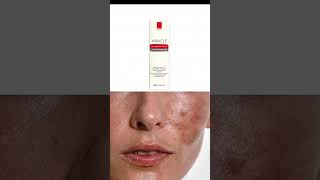 Melasma Treatment in urduMiracle Creamhyperpigmenttation cream benefits in urdu [upl. by Annahsed743]