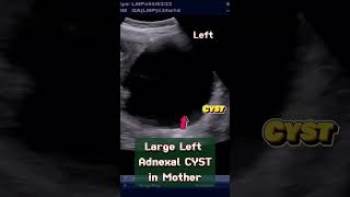 Large Ovarian Cyst in Mother with Normal Pregnancy of 33 wks ultrasound pregnancy baby [upl. by Ahsoik470]