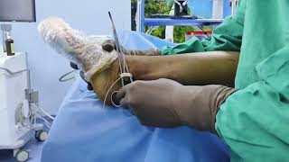 Peroneus longus tendon harvest for ACL Graft [upl. by Palma485]