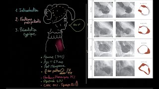 Cardiomyopathie de Takotsubo  Docteur Synapse [upl. by Oisorbma541]