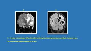 Neurology Quiz 80 Rasmussens encephalitis [upl. by Trinee414]