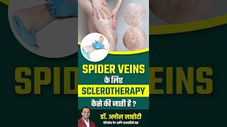 Treating Spider Veins with Sclerotherapy dramollahoti varicoseveins youtubeshorts [upl. by Ulises]