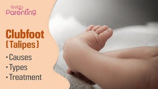 Club Foot Talipes in Babies  Causes Signs amp Treatment [upl. by Lledyr595]