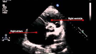 6B Parasternal short axis view of the left atrium and aorta Pulmonary Hypertension [upl. by Ynavoeg]